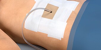 Critical Tube Securement Surgical Drain Application video
