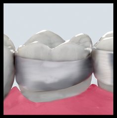 Bandas de ortodoncia