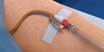 Critical Tube Securement Foley Platform Application video
